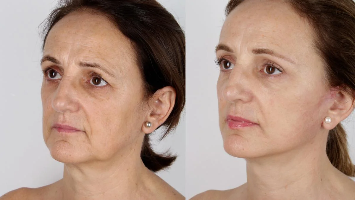 Understanding the Ozempic Face: Managing Rapid Weight Loss Effects